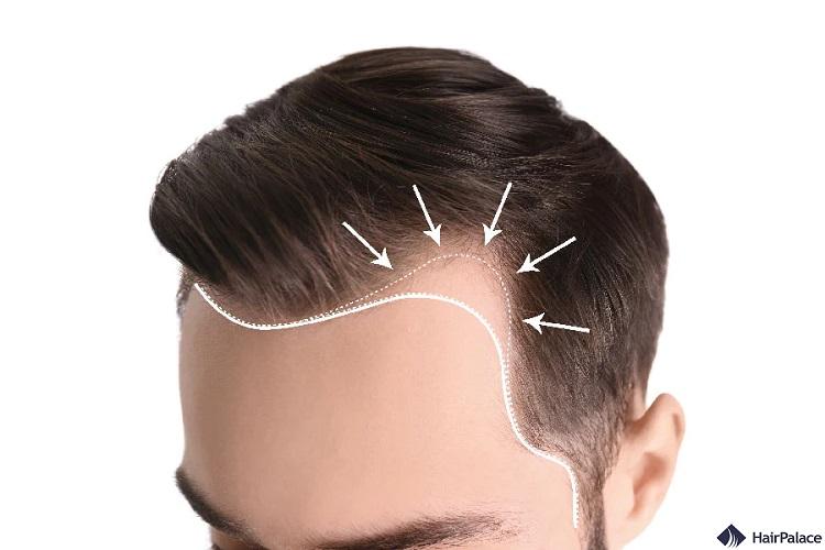 The Importance of Hairline Design in Hair Transplant