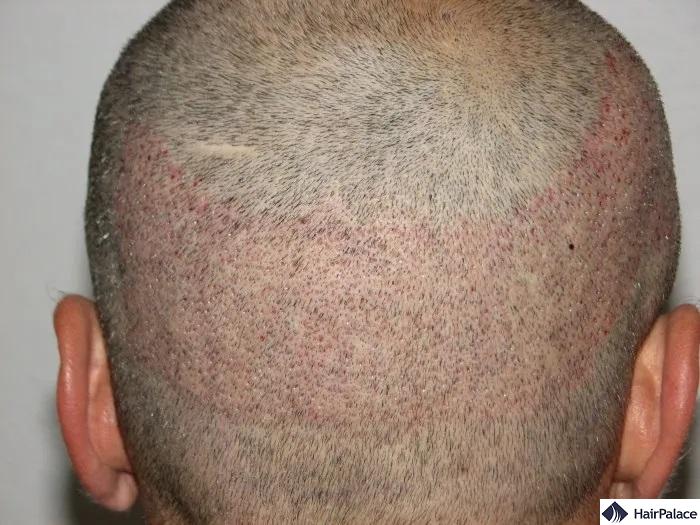 The surgery leaves tiny hair transplant holes after the srugery is finsihed