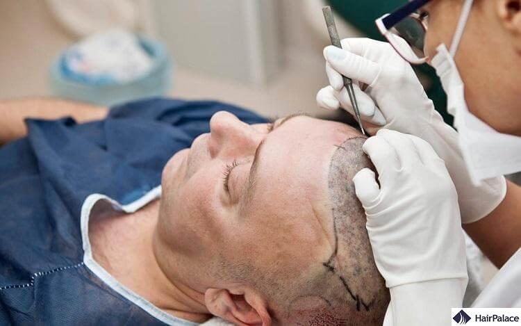 mens hair transplant operation
