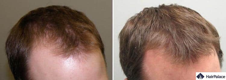 Topical Finasteride for Hair Loss: Efficacy, Side Effects and Results