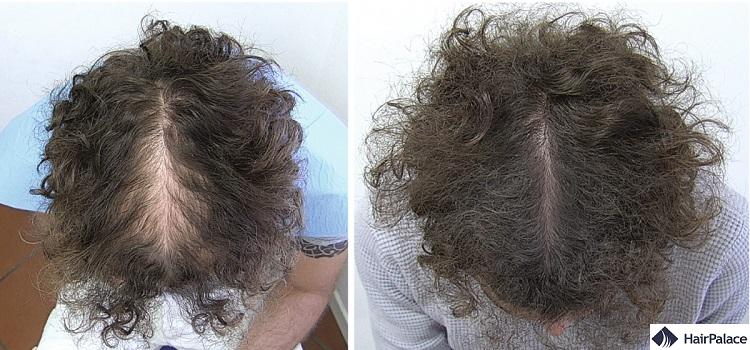 Finasteride buy ireland