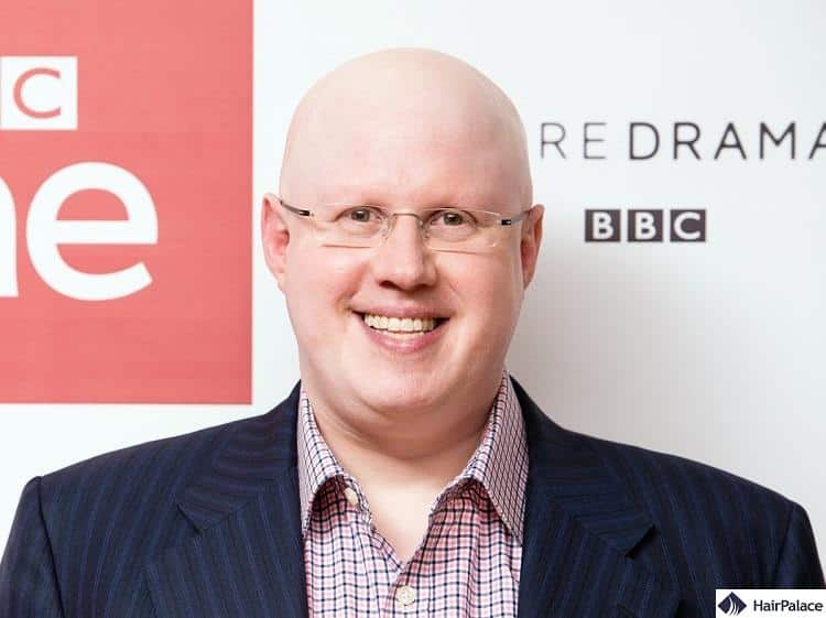 Matt Lucas is one of the most well known celebrities iwth alopecia