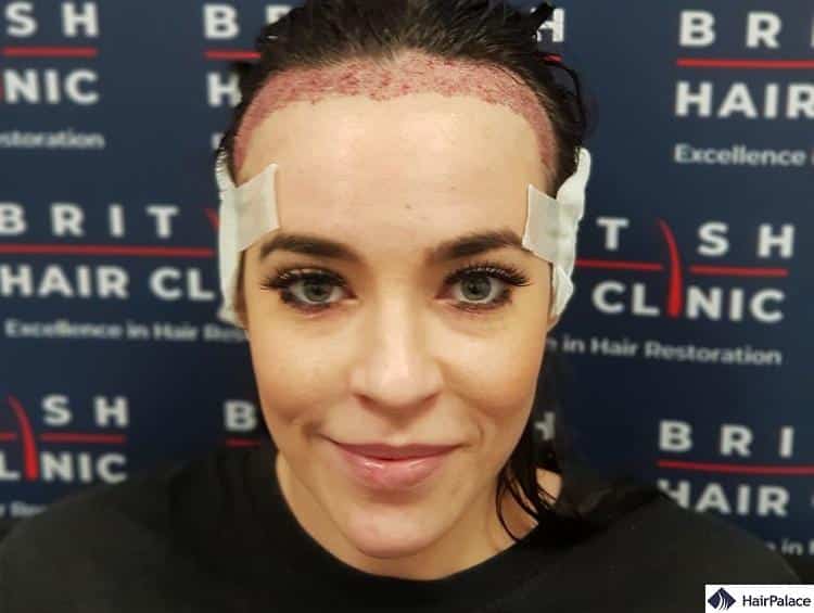 Stephanie Davis is another one of famous british celebrities with alopecia