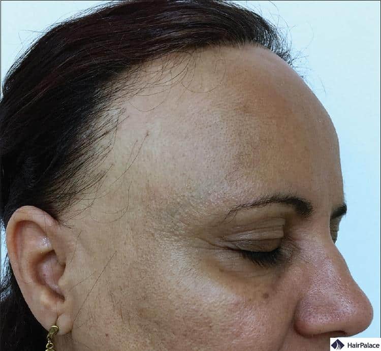 the symptoms of frontal fibrosing alopecia may look something like this