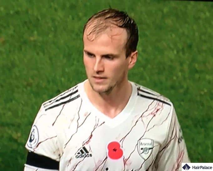 Rob Holding hair loss