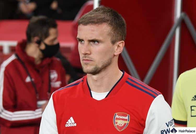 Rob holding hair transplant final results