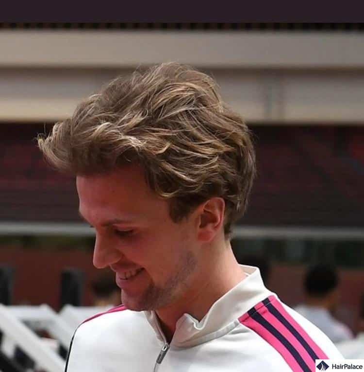 Rob Holding hair after his surgery