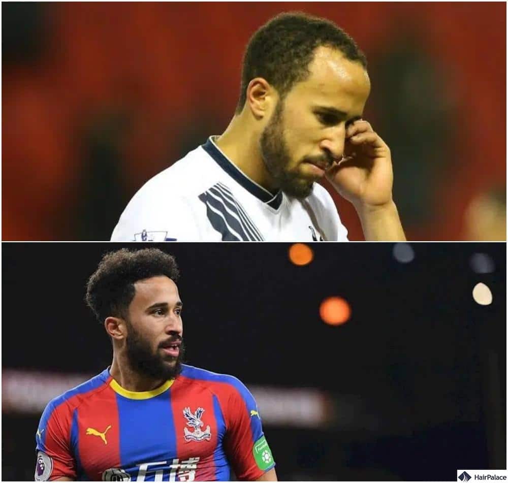 Andros Townsend is another well known hair restoraiton patient