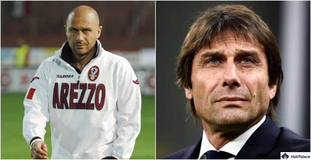 Antonio Conte's surgery marks one of the first known cases of a footballer hair transplant