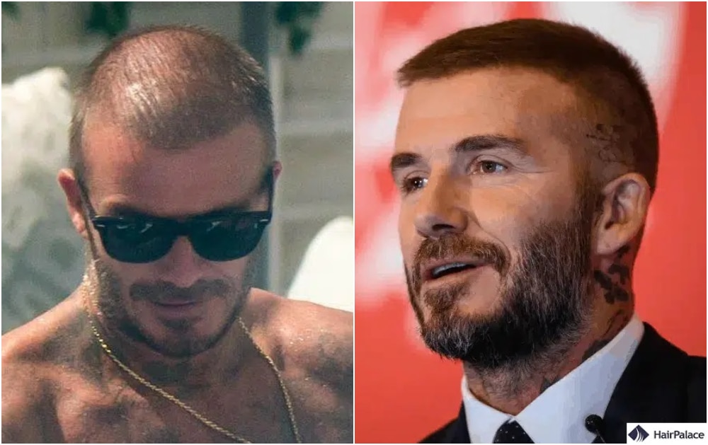 David Beckham had a footballer hair transplant shortly after his retirement