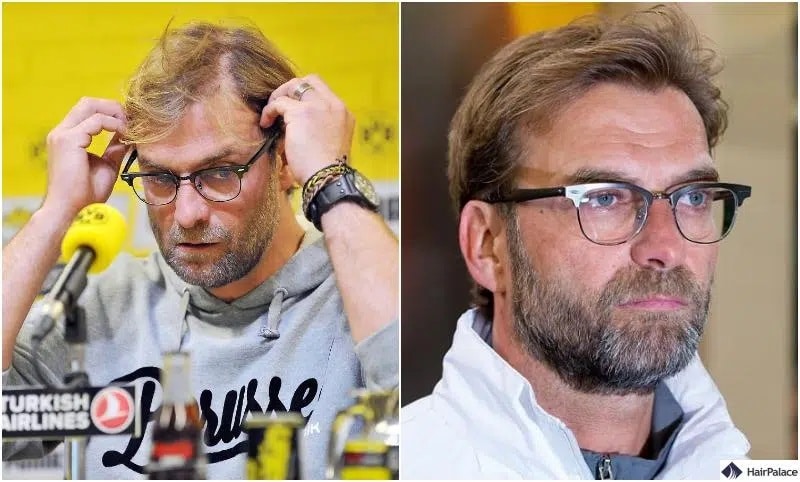 Jurgen Klopp before and after surgery