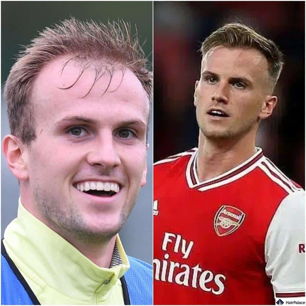 Rob Holding before and after his hair transplant