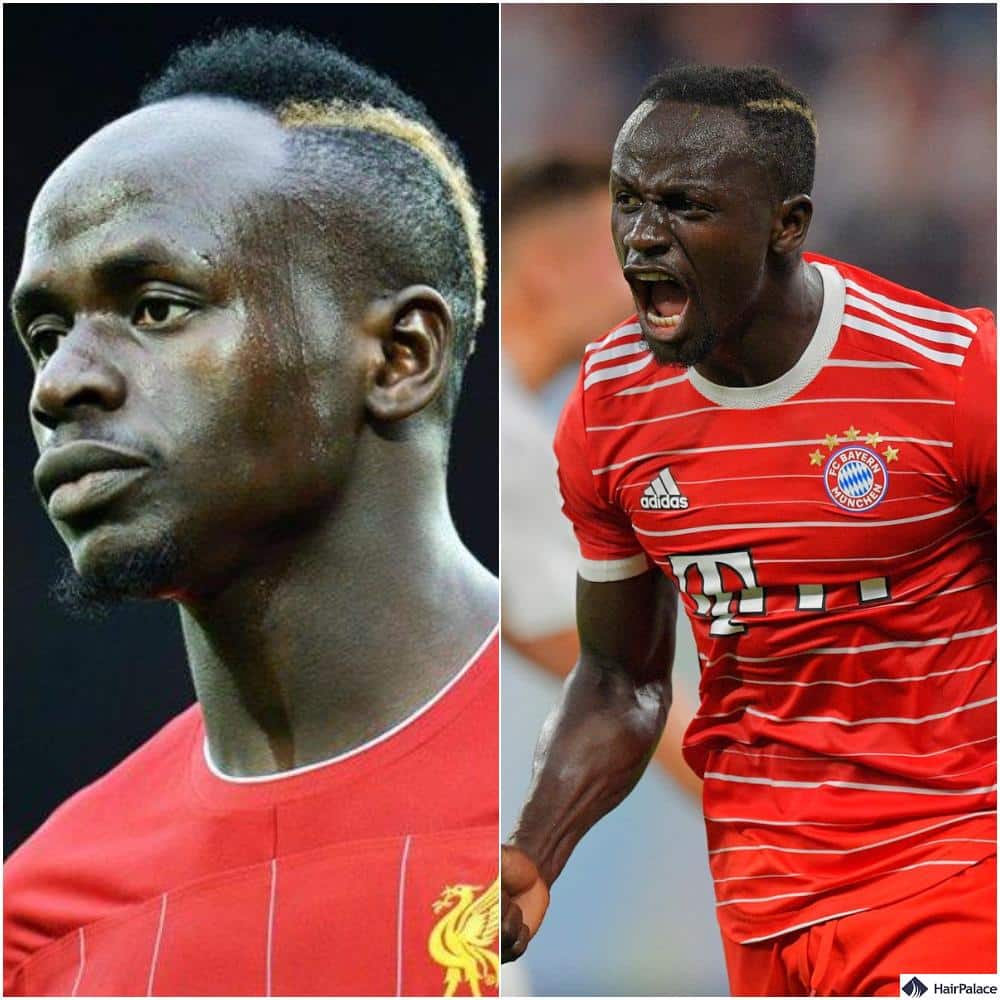 did Sadio Mane haive a  hair transplant?