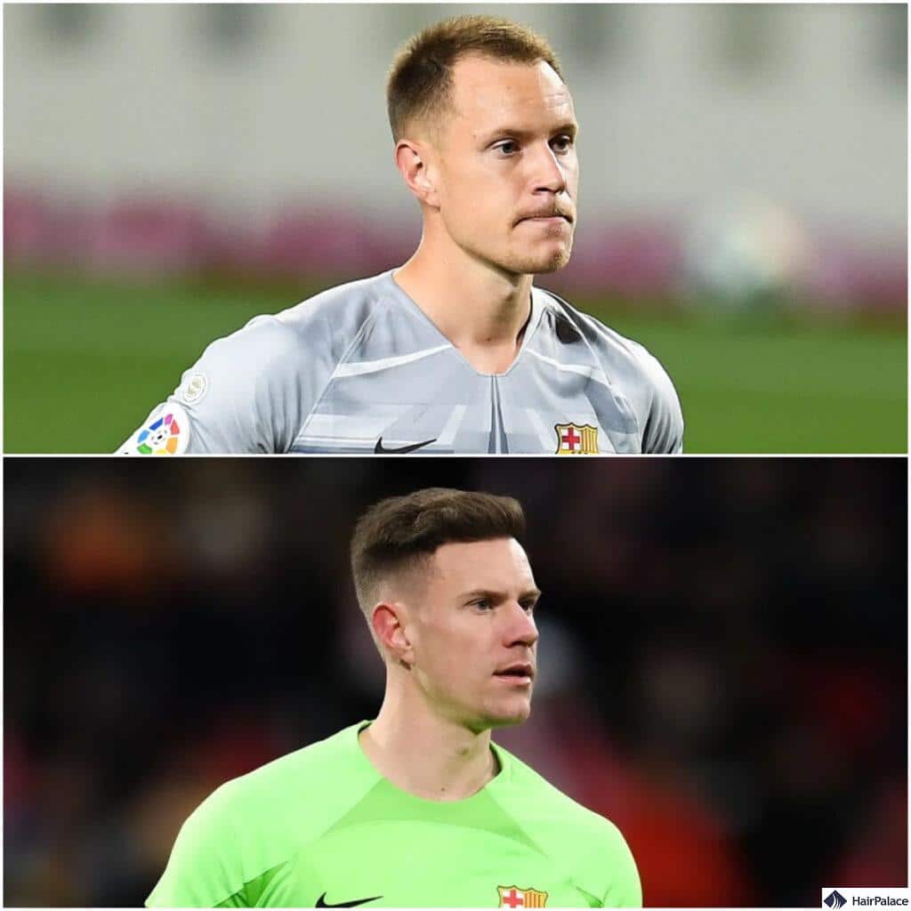 Marc Andre ter Stegen before and after his hair transplant