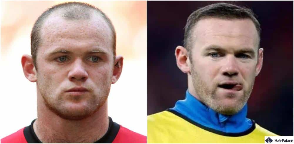 The Wayne Rooney hair transplant costed nearly 30,000 pounds