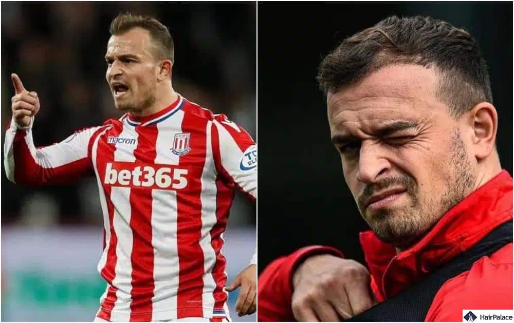 Xherdan Shaqiri is the first person on our list with a botched footballer hair transplant