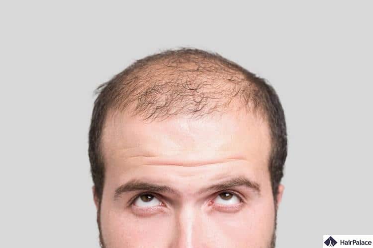 androgenic alopecia can cause frontal hair loss, but there are many other factors among the possible causes