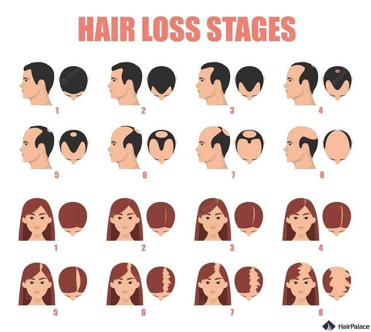 Difference between male and female pattern hair loss