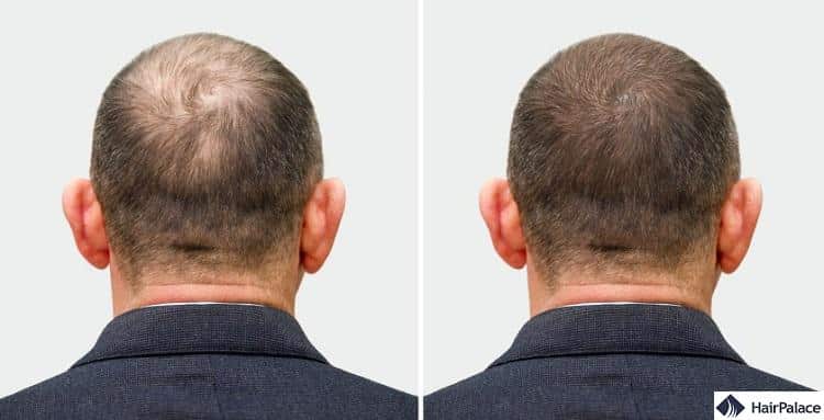 prp treatment for male hair loss