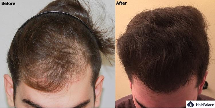 PRP Treatment for Hair Loss Benefits