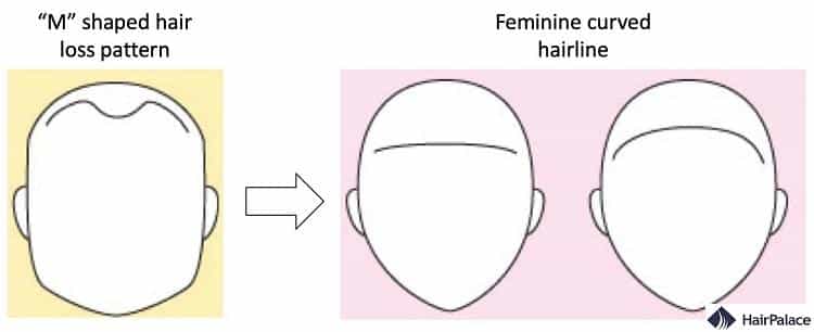 transgender hairline