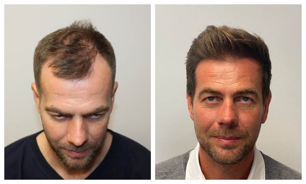 Hair Transplant After 14 Days: Photos, Results, Side Effects - Blog -  Wimpole