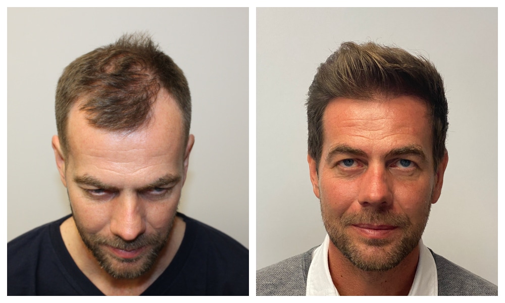 Hair Transplant Before And After