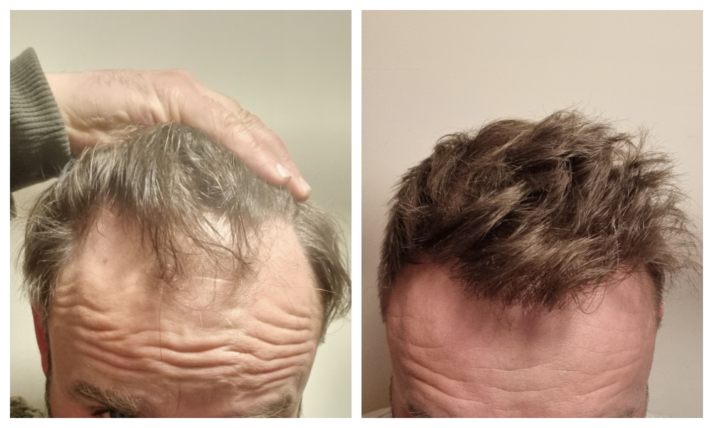 hair transplant before and after with 4155 hairs