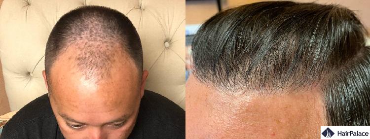 before and after a fut hair transplant