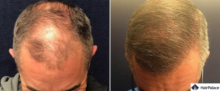 fut hair transplant can lead to stunning results