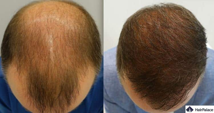 results of a fut hair transplant