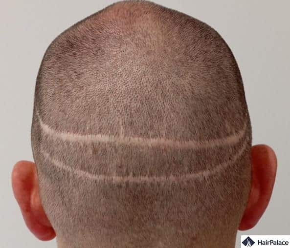 fut hair transplant leaces a large linear scar