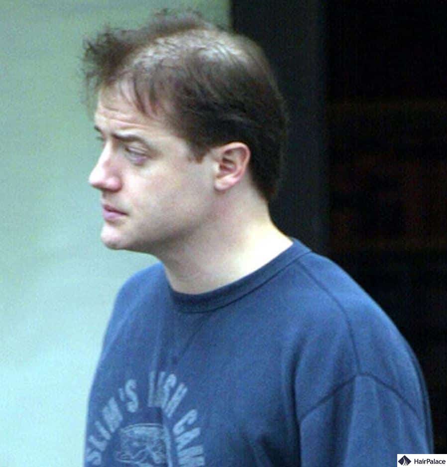 brendan fraser hair loss started in 2003