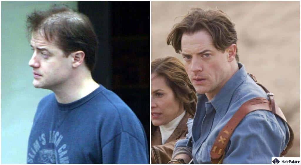 brendan fraser hair transplant before and after