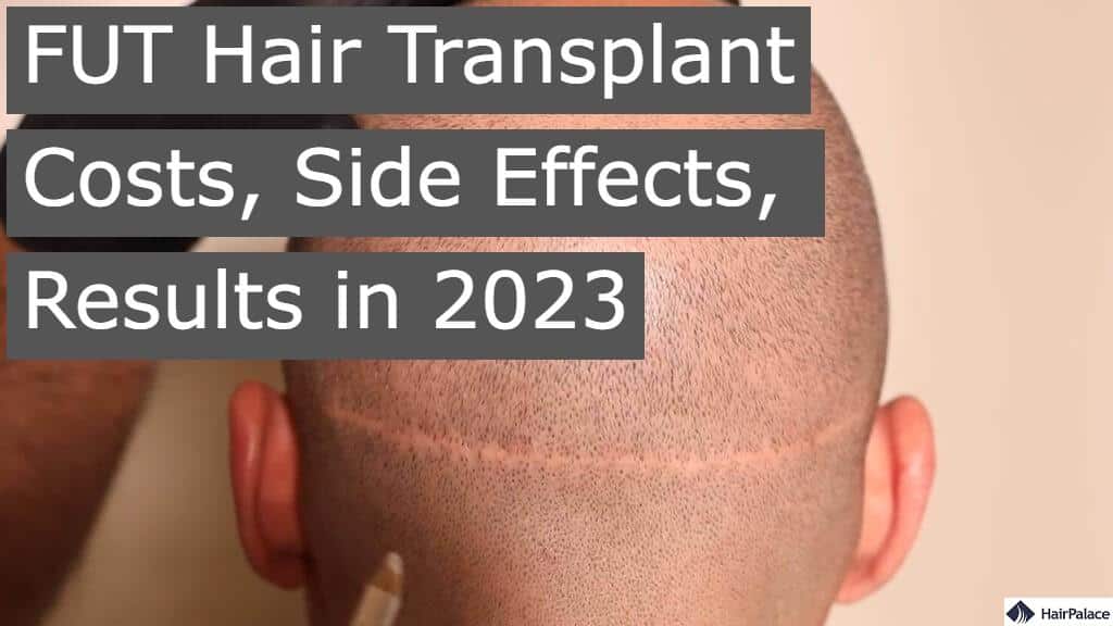 FUT hair transplant costs side effects results in 2023