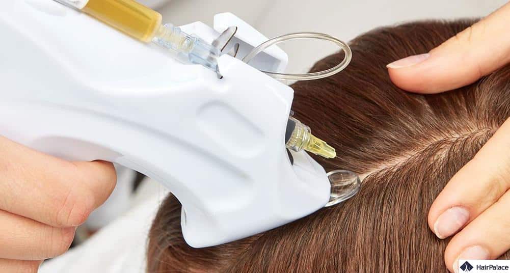 prp hair loss treatment in action