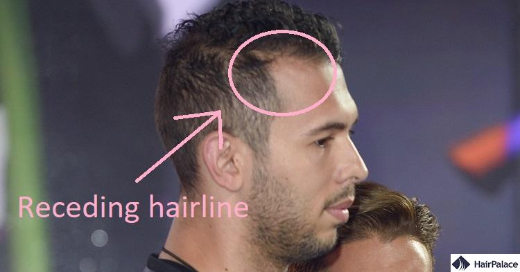 andrew tate hair loss in the big brother