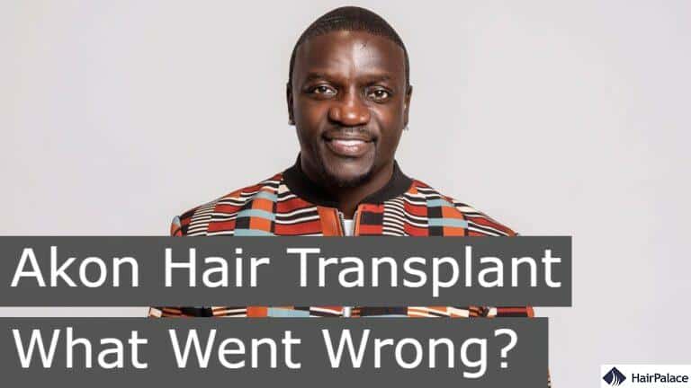 Akon Hair Transplant | What Went Wrong?