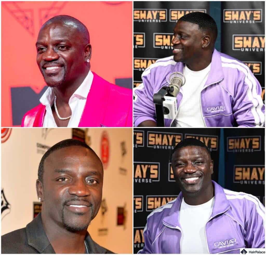 akon hair transplant before and after