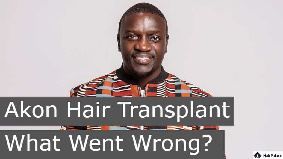 akon hair transplant what went wrong