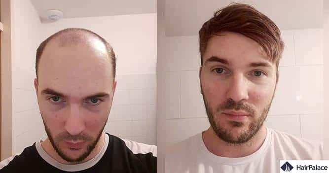 results of a hair replacement system