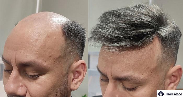 non-surgical hair replacement treatment
