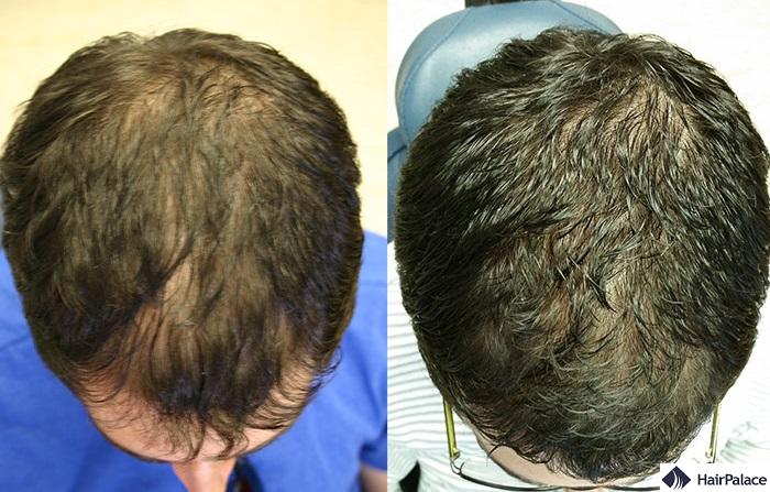 laser hair treatment before and after