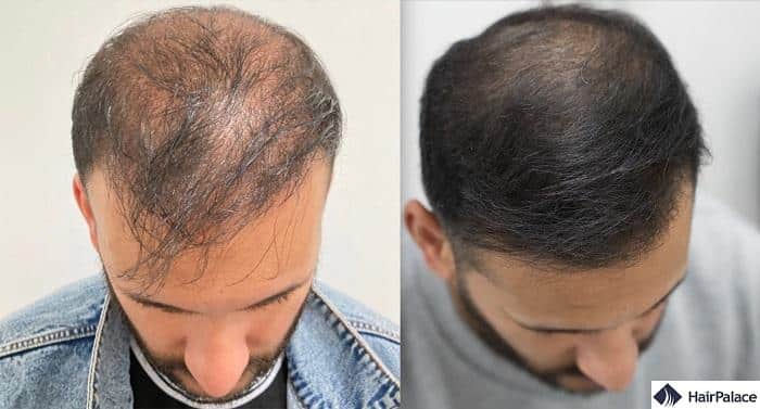 laser hair treatment before and after photo