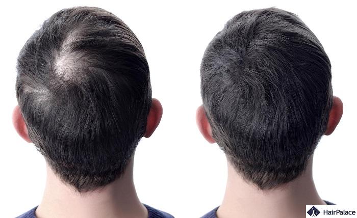 laser therapy for hair loss before and after