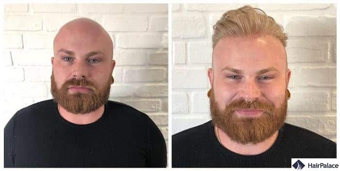 hair replacement UK