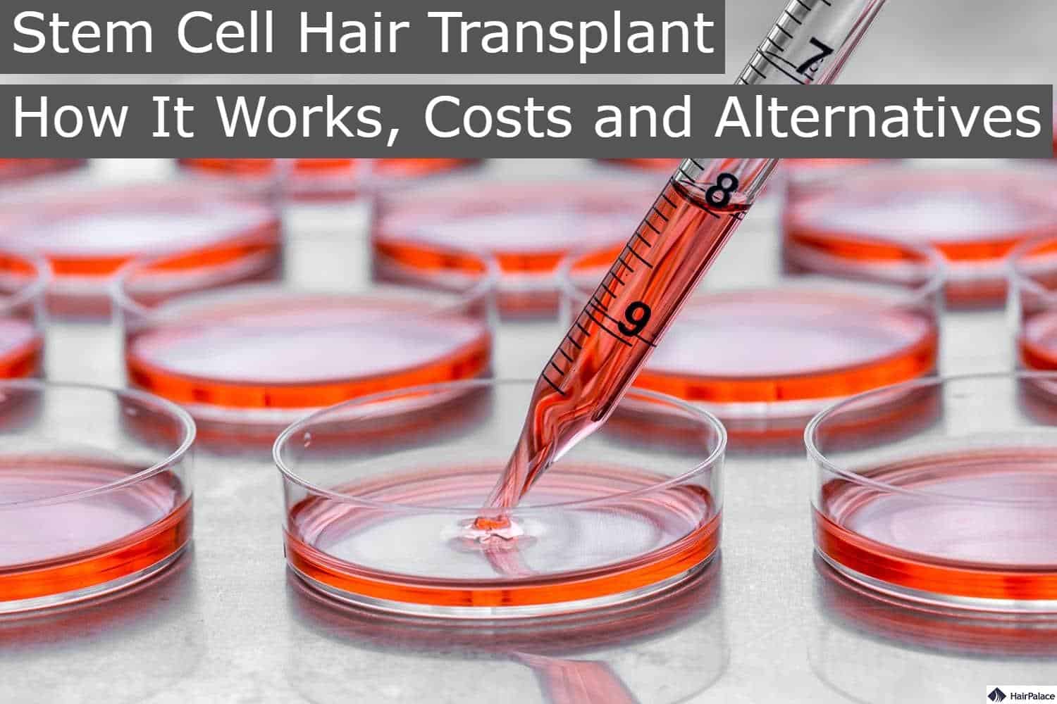 stem cell hair transplant how it works costs and alternatives