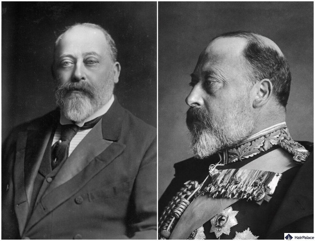 King edward hair loss and receding hairline