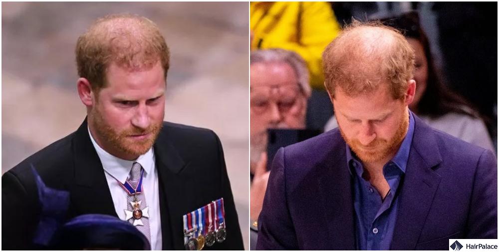 prince harry hair loss evolution