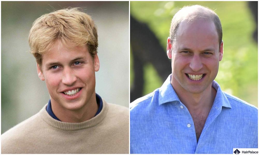 prince william hair loss